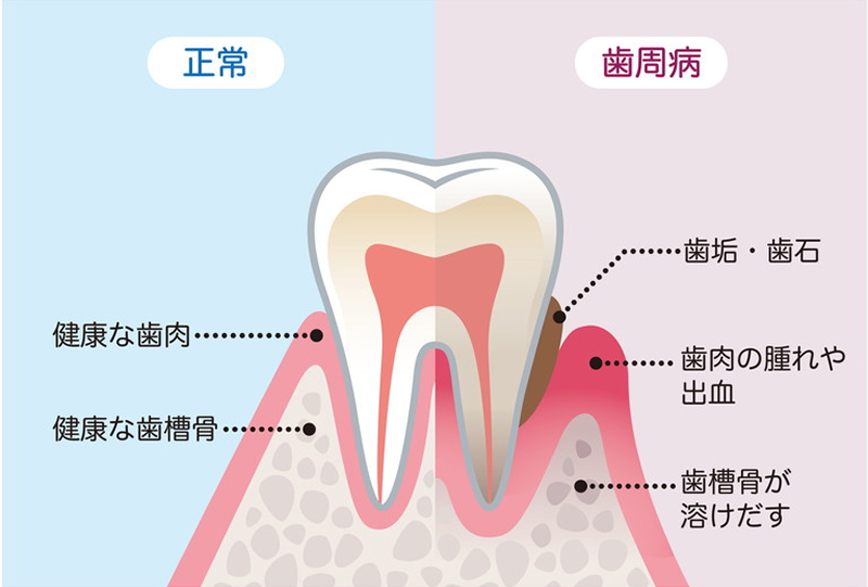 正常な歯と歯周病の状態を比較した図。左は健康な歯肉と歯槽骨、右は歯垢・歯石の付着や歯肉の腫れ、歯槽骨の溶解が見られる歯周病の状態を示している。